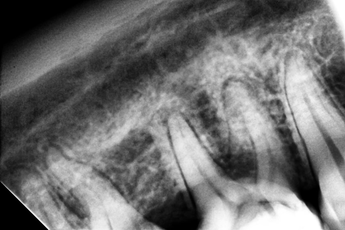 Woodpecker® i-Sensor Digital X-Ray Sensor--Buy 2 get 1 for FREE, valid till Dec 31st, 2025