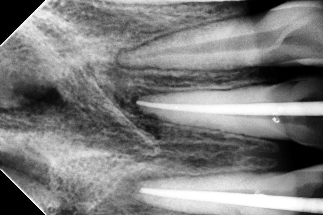 Woodpecker® i-Sensor Digital X-Ray Sensor--Buy 2 get 1 for FREE, valid till Dec 31st, 2025