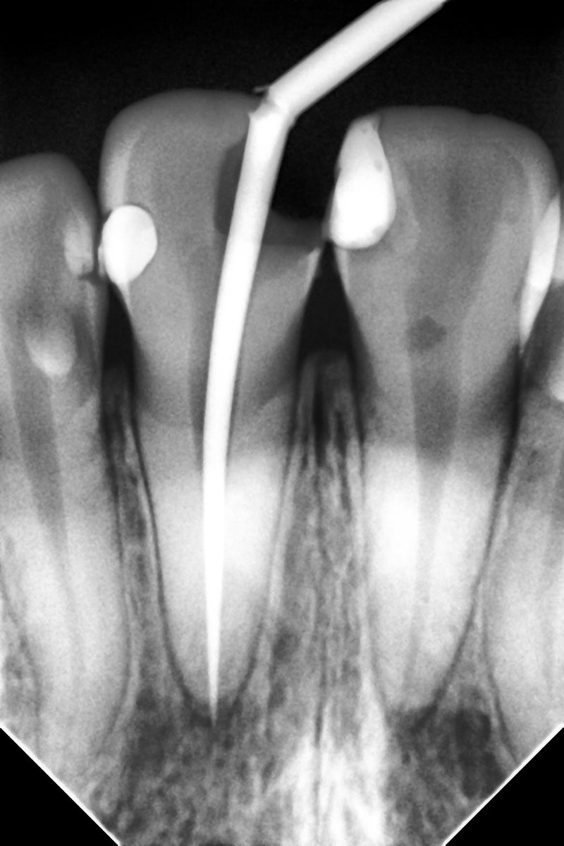 Woodpecker® i-Sensor Digital X-Ray Sensor--Buy 2 get 1 for FREE, valid till Dec 31st, 2025