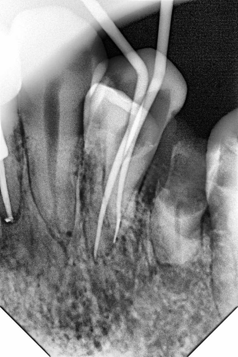 Woodpecker® i-Sensor Digital X-Ray Sensor--Buy 2 get 1 for FREE, valid till Dec 31st, 2025