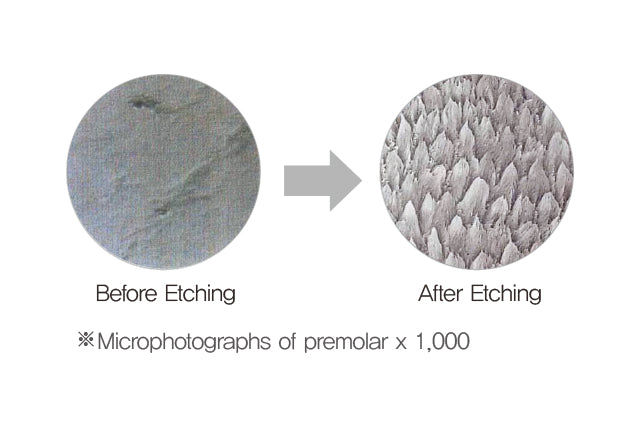 DenFil Etchant 3ml x 12 Syringes, Disposable tips (Blue)